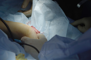 Fractured Bone In a Hand