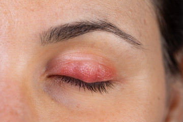 Naklejka premium Macro of a woman's eye with swollen and inflamed eyelid, symptoms of blepharitis