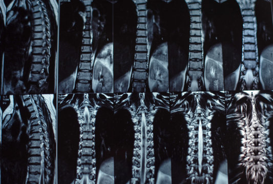 Magnetic resonance imaging of the human spine. Hernia on the spine. Selective focus.