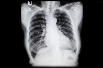 Set chest x-ray film taken to examine the heart. Healthcare and Medical concept.