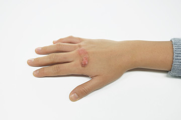 Scalded hand of woman with injury by boiling water burn. After healing 5 days.