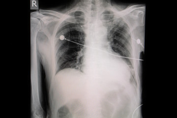 Set chest x-ray film taken to examine the heart. Healthcare and Medical concept.