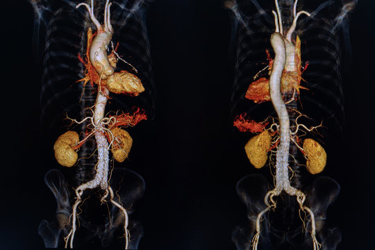 X-ray Medical Scan In Hospital. CTA, CT Angiography 3D Rendering Image, CT Scan. Healthcare And Medical Concept.