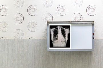 Chest X-rays with negatoscope on wall. Healthcare and Medical concept.