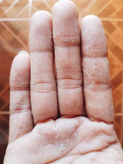 Fingers Skin peeling due to allergic reaction