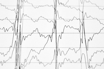 Close-up photo of EKG graph. Medical background
