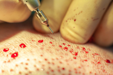 Patient's head close-up. Baldness treatment. Hair transplant. Surgeons in the operating room carry...