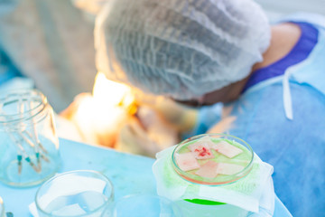 Baldness treatment. Hair transplant. Surgeons in the operating room carry out hair transplant surgery. Surgical technique that moves hair follicles from a part of the head.