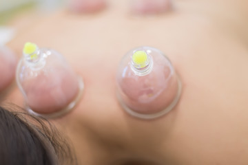 Naklejka premium Hijama - the treatment of bloodletting. Attached vacuum cup.