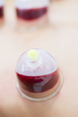 Hijama - the treatment of bloodletting. Attached vacuum cup. Blood fills in the cup.