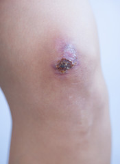 Fototapeta premium Scar and scab (eschar) on asian female knee