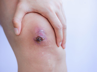 Scar and scab (eschar) on asian female knee