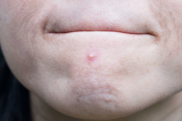 Fototapeta premium Acne pimple on nose in Asian woman skin face close up.