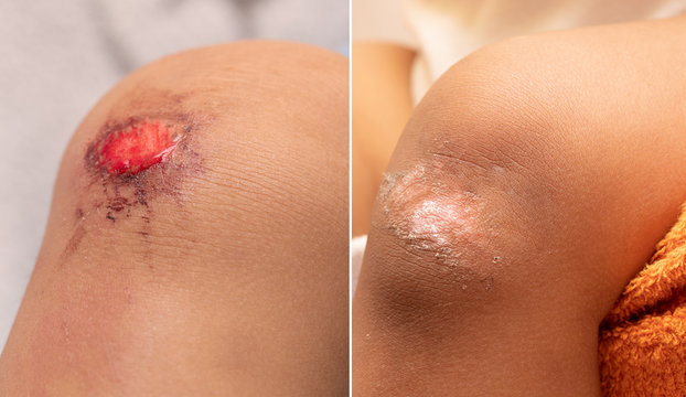A before and after view on the grazed knee of a young child. Fresh and bleeding wound is seen on the left and new, healed skin with slight scabbing is seen on the right after healing period.