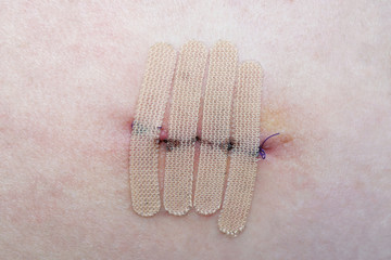 close-up of human skin with suture and wound closure strips or surgical tape after mole or melanoma...