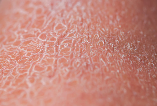 background of skin texture close-up covered with small and large cracks and dead dry flaky scales after sun exposure