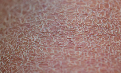 dry unhealthy skin texture covered with small and large cracks and dead flaky scales