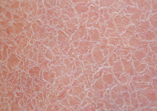 background of unhealthy skin texture close-up covered with small and large cracks and dead dry flaky scales