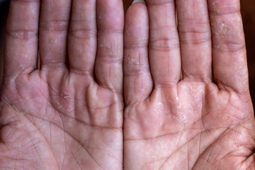 Fingers Skin peeling due to allergic reaction