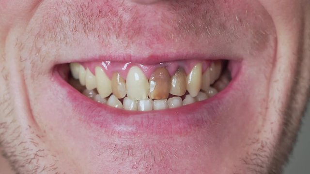 Man at a dentist showing crooked teeth