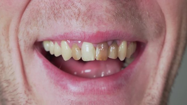 Man with bad teeth laughing, closeup