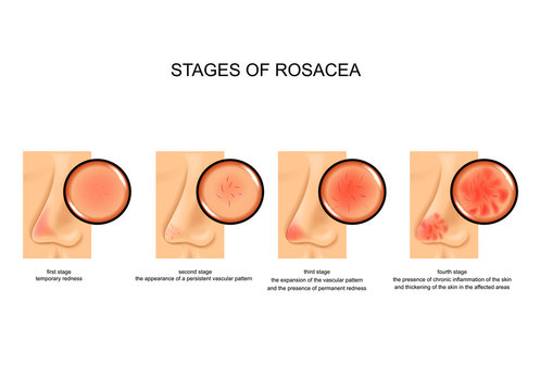 stages of rosacea