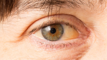 A close-up view of a jaundice eye in a Caucasian person. Yellowish tint in the whites of the...