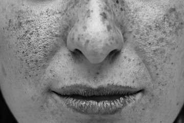 A close up view of a woman’s face. UV light on the cheeks, nose and lips. Showing damage and...