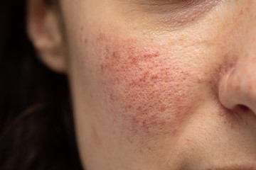 A closeup view on the face of a Caucasian girl with small superficial dilated blood vessels on the...