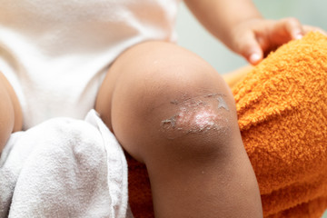 The leg of a young child is seen whilst recovering from an injury. A healed wound is seen with...