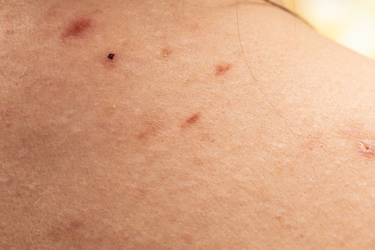 A close-up view of insect bites on human skin, towards the upper back and shoulders. Scabbed wounds similar to those of tick bites.