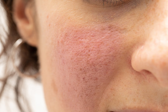 A closeup view on the rosy cheek of a thirty something Caucasian girl. Redness and slight swelling after undergoing a procedure to remove superficial blood vessels caused by a skin disorder.