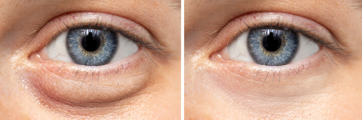 A before and after view on the eyes of a pretty young Caucasian woman, one show puffy dark circles...