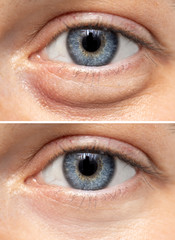 A split screen view on the eyes of a young Caucasian girl, one show fluid retention beneath the...