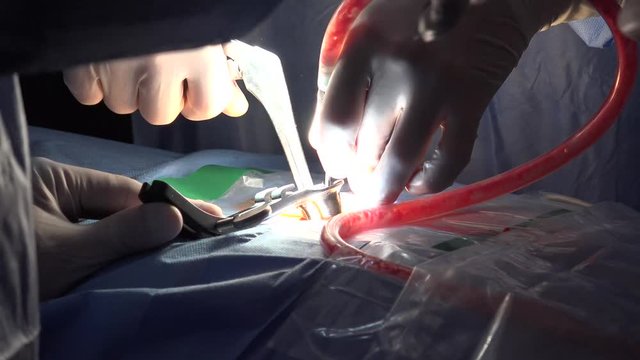 Spinal disc herniation is an injury to the cushioning and connective tissue between vertebrae, usually caused by excessive strain or trauma to the spine.