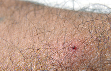 tick bite macro