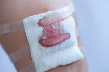 Close up on a scraped human Knee gauze