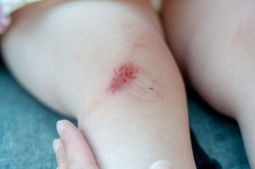 Blur image of fresh wound on knee, Fresh bruise knee wound injury with some small stone and dust...