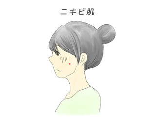 ニキビ肌の女性