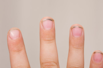 Dirty long nails have germs make sick. Dirt under the nails of a child. Hygiene children's hands