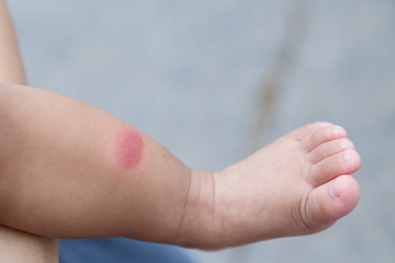 The child bit a mosquito in the leg, itches, redness, a wound, a scratch. Baby new born with red...