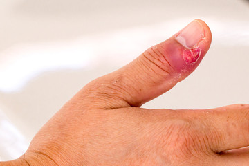 Paronychia, swollen finger with fingernail bed inflammation due to bacterial infection on a...