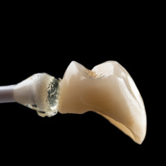 single unit press ceramic crown