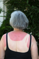 Ältere Frau mit einen starken Sonnenbrand auf dem Rücken