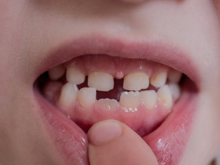 Cute baby shows dropped baby tooth. Child smiles with toothless mouth. Lips and teeth close up