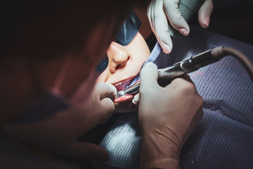 Closeup photo shoot of process of dental operation over small boy by expirienced dentist.