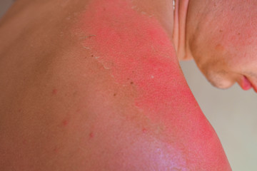 Sunburned man. Sunburned heavily, white skin versus very dark red and burned