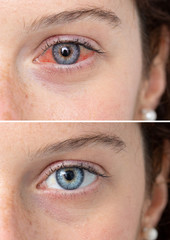 Conjunctivitis, red eyes, treatment