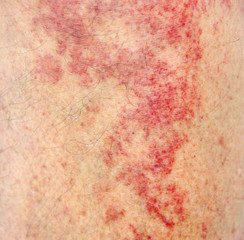 Allergic contact dermatitis at shin