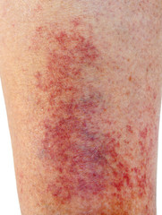 Allergic contact dermatitis at shin